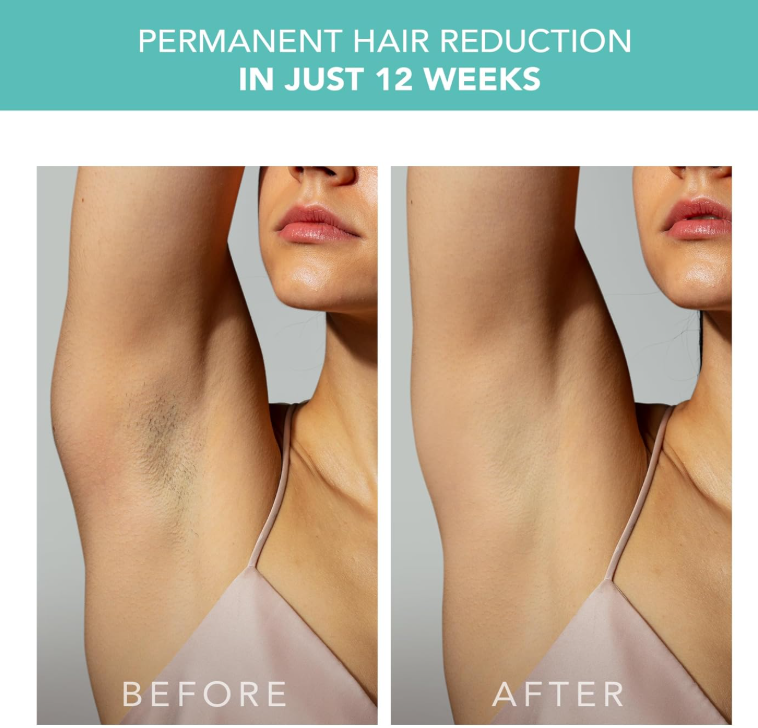 Foreo PEACH™ 2 IPL Hair Removal Treatment